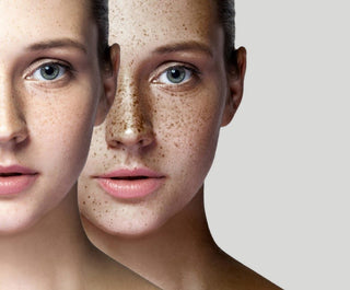 Bilde som viser ansikt med hyperpigmentering, mørke flekker forårsaket av økt melaninproduksjon, som kan behandles for jevnere hudtone.