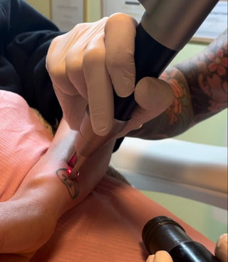 Tatoveringsfjerning med skånsom laserbehandling hos Ljoma Hud i Oslo.