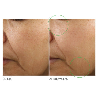 Før og etter bilder, 2 uker etter bruk av Dr. Dennis Gross Advanced Retinol + Ferulic Intense Wrinkle Cream 50ml.