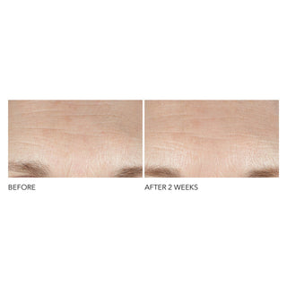 Før og etter bilder av panne etter bruk av Dr. Dennis Gross Advanced Retinol + Ferulic Intense Wrinkle Cream i 2 uker.