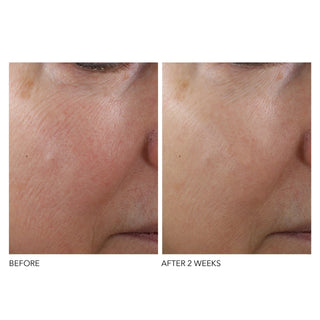Før og etter bruk av Dr. Dennis Gross Texture Renewal Serum, 2 uker. 