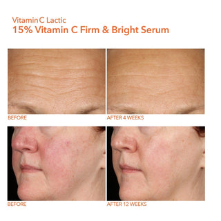 Før og 2 uker etter bruk av Dr. Dennis Gross Vitamin C Lactic 15% Firm & Bright Serum.