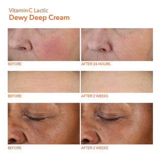 Før og 24 timer/2 uker etter bruk av Dr. Dennis Gross Vitamin C Lactic Dewy Deep Cream.