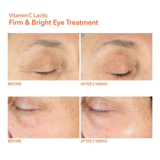 Før og 2 uker etter bruk av Dr. Dennis Gross Vitamin C Lactic Firm & Bright Eye Treatment.