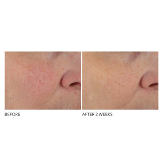 Før og etter Dr Dennis Gross Overnight Texture Renewal Peel.
