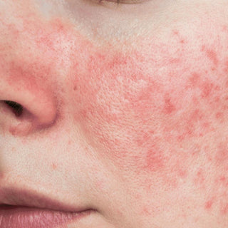 Bilde som viser rød og irritert hud med rosacea, behandlet for å redusere rødhet og forbedre hudens helse