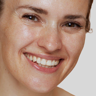 Modell med jevn og avslappet hud som illustrerer resultatet av rynkebehandling med botox hos Ljoma Hud i Oslo.