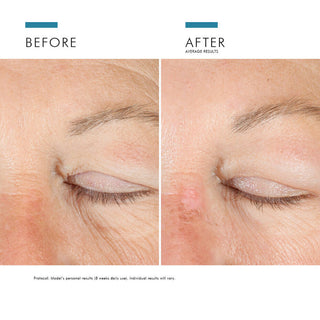 Før og etter bilde av SkinCeuticals A.G.E. Advanced Eye som viser resultater og forbedring av mørke ringer. 