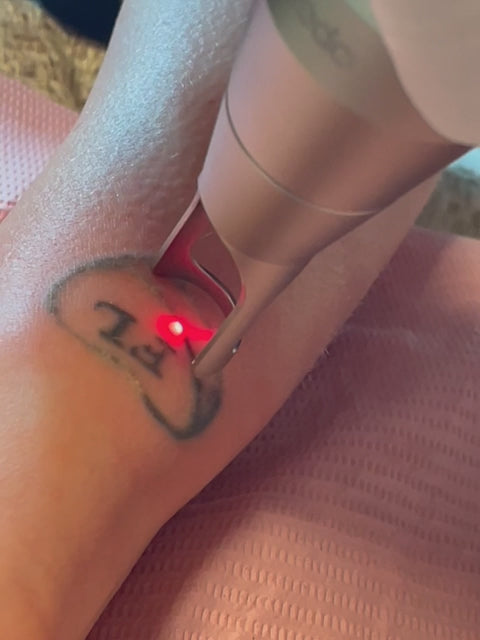 Tatoveringsfjerning med laser i Oslo. 